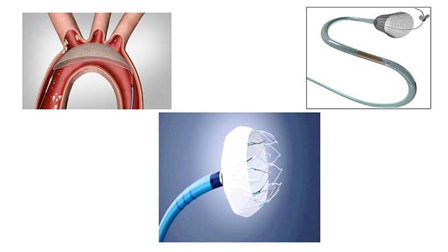 fa global transcatheter embolization occlusion devices market